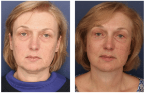 Before and after image of woman who received beautiful facelift from Dr. Schuster